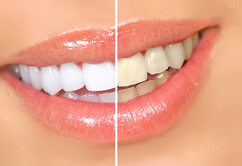 Teeth-Whitening1